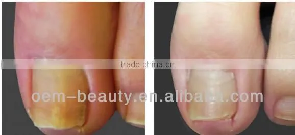 Good depilacion laser nd yag laser spider vein removal machine in hot sale