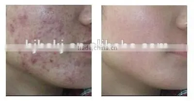 new Rhytidectomy Fraction erbium glass fractional laser