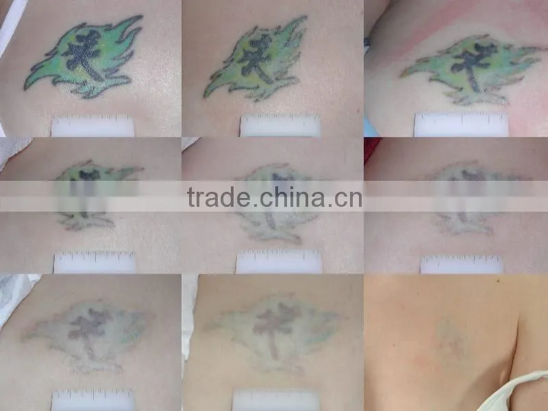 High quality professional q switch nd yag laser 1064mm&532nm machine