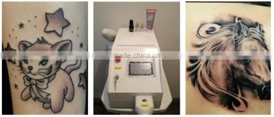 ND YAG Q-Switch laser best tattoo ND yag laser tattoo removal 1064nm and 532nm laser nd yag laser/ medical