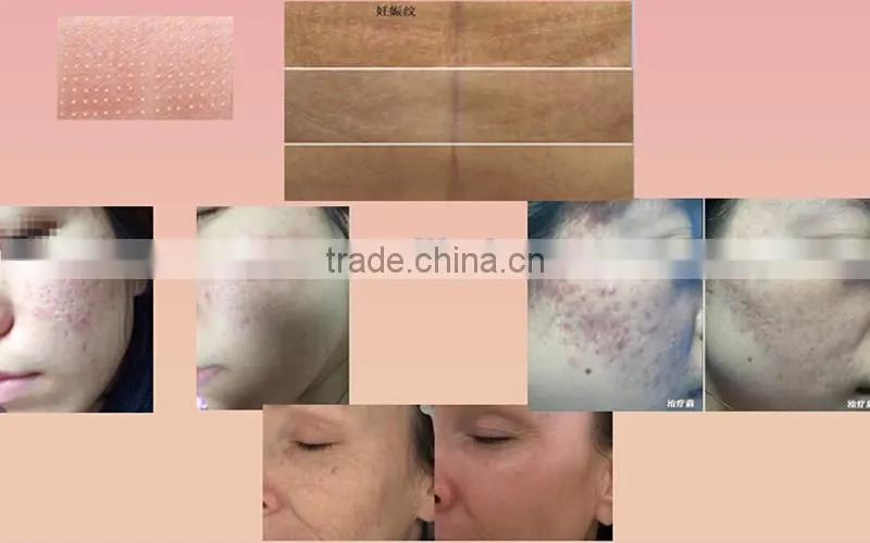 New technology fractional co2 laser scar removal, fractional co2 vagina rejuvenation laser