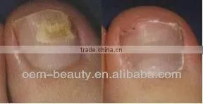 Most salable infrared laser hair removal machine for spider vein/ toenail fungus treatment