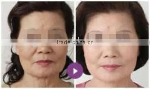 The Portable E-light And RF Beauty Machine