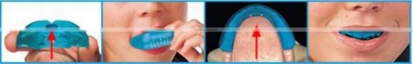 Best selling Orthodontics for tooth/teeth trainer
