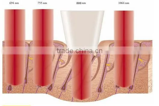 2016 Hottest 808nm diode laser, portable laser hair removal, 808nm diode laser hair removal machine for sales