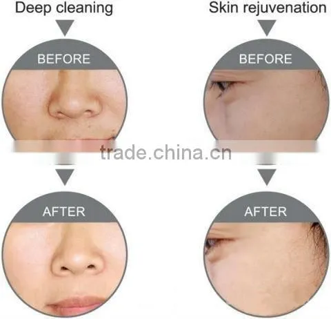 diamond microdermabrasion diamond peel machine portable microdermabrasion machine for sale HD1.0