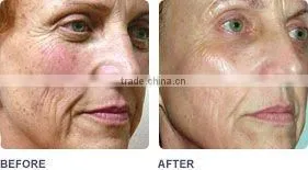 portable face slimming device