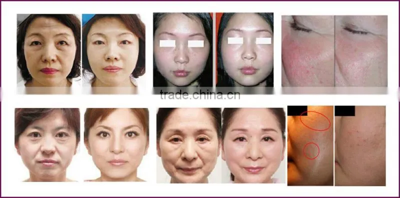 Hot selling oem skin whitening auto micro needl therapi system