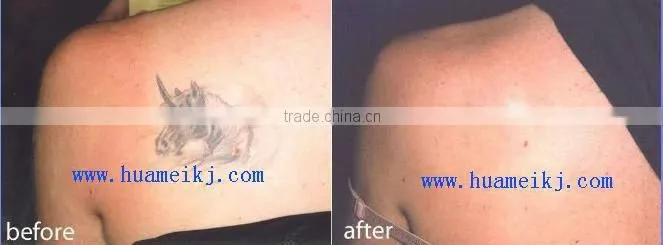 Q-switched Nd Yag laser for all color tattoo removal