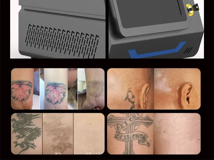 Portable Pico Laser Pigmentation Tattoo Removal Laser 755nm Pigment Removal Beauty Machine