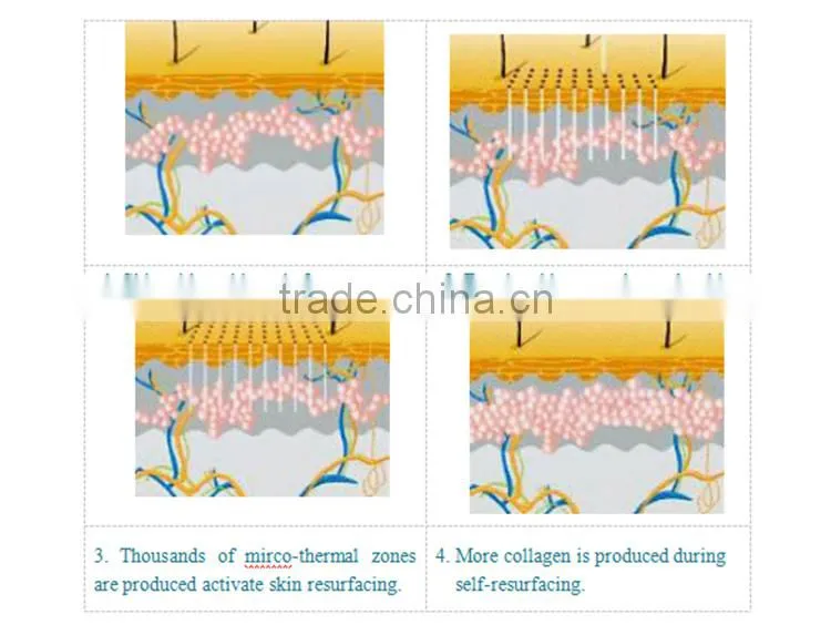 Fractional CO2 Laser Skin Resurfacing Scar Removal Stretch Mark Removal