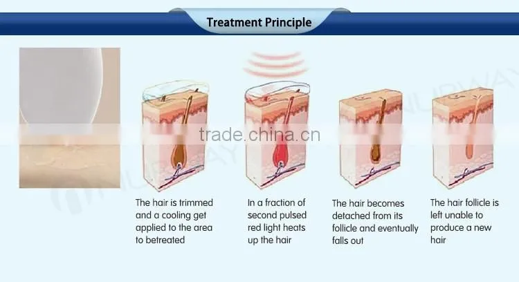 Most effective dark skin hair removal! diode laser permanent hair removal device