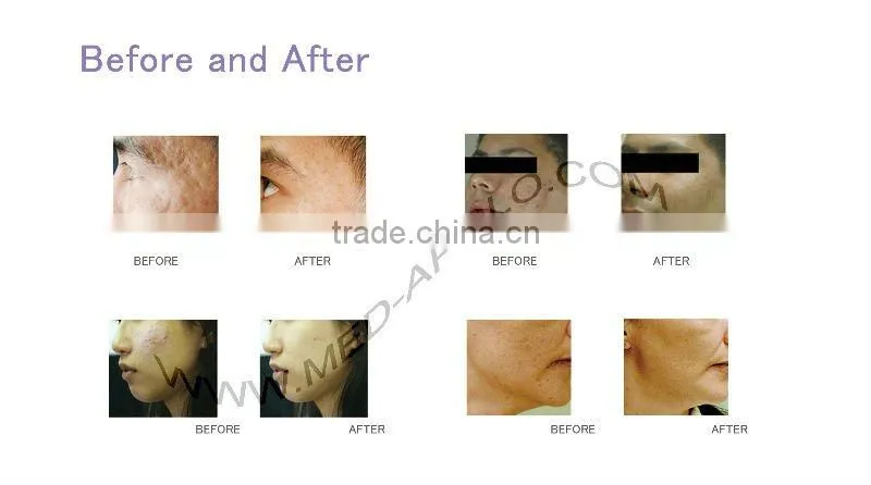 Apolomed Portable diamond and crystal microdermabrasion machine for sale