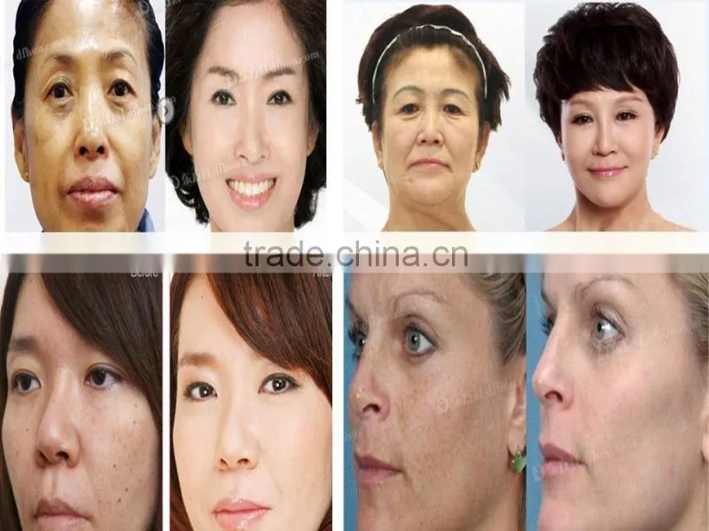 beauty studio nd yag laser tattoo removal treatment head machine D006