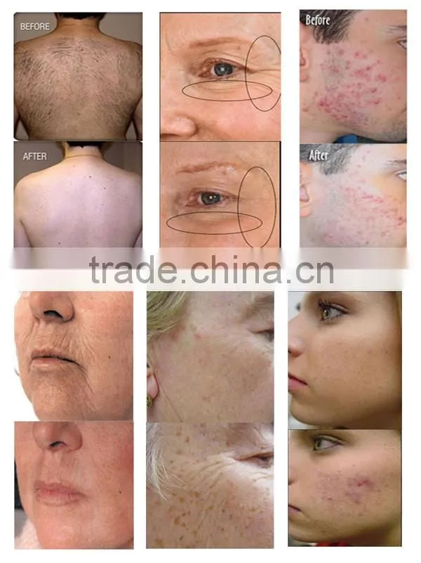 New hottest portable IPL Factory provide hottest selling portable e-light portable ipl portable
