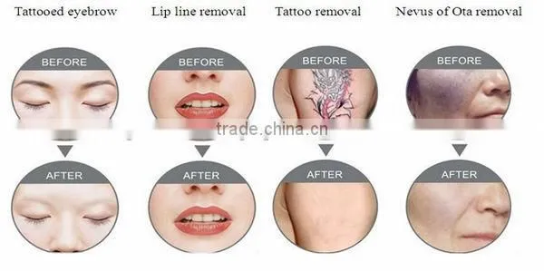 nd yag laser hair removal / tattoo removal laser equipment