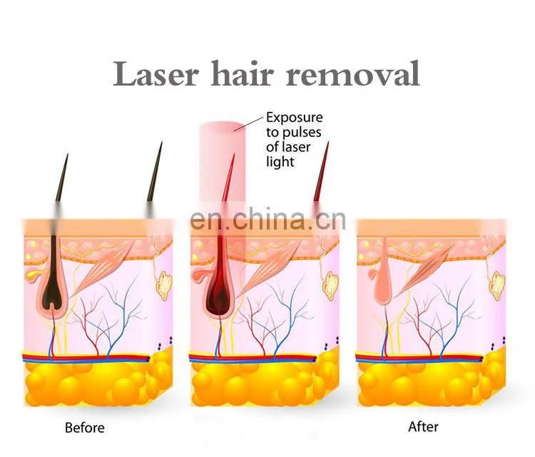 808nm Diode Laser Portable Facial Legs and Arms Area Permanent Hair Remover Hair Removal Machine