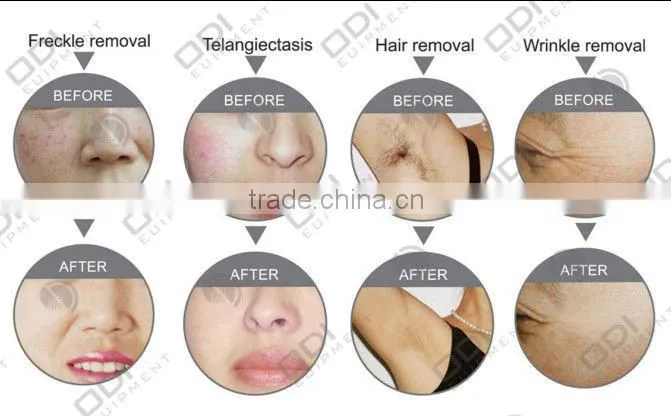 tattoo removal q-switch laser hair removal e light rf ipl machine OD-IRL10 multifunctional home nd yag laser