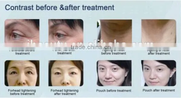 2015 professional portable HIFU High Intensity Focused Ultrasound HIFU with 3 tips for wrinkle removal