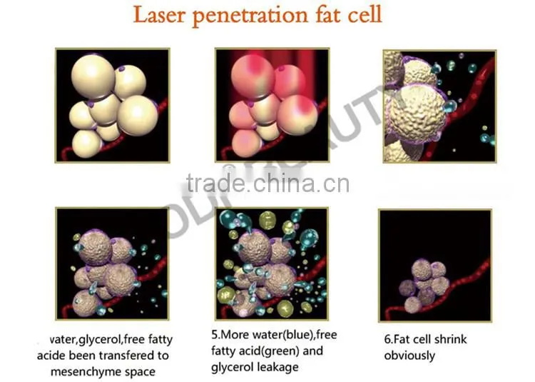 OD-S30 BV Approved Intelligent fat reducing slimming smart lipo laser