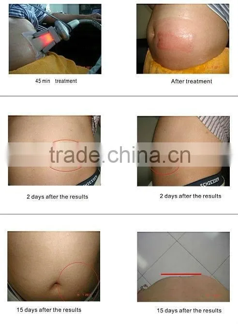 Cryo fat cryotherapy antifreeze membrane for lipo cryo Machine