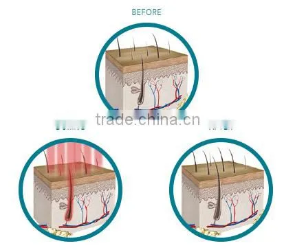 laser hair regrowth machine/ hair laser machines for hair loss