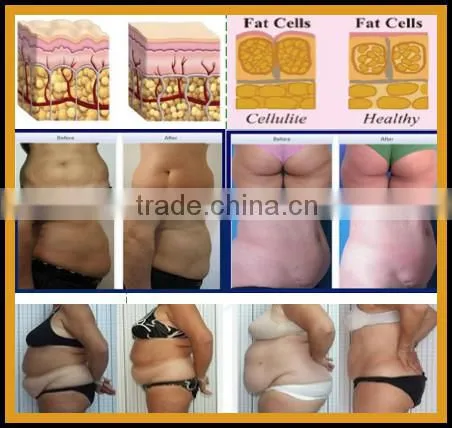 Vertical cryolipolysis liposuction treatment +Ultrasonic Vacuum cavitation slimming machine