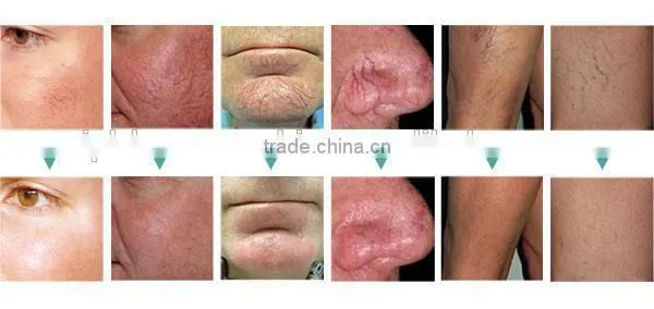 Cheapest 2016 ! Popular professional facial laser for home use