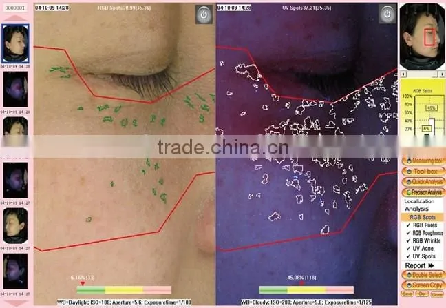 Skin Analyzer Type Portable Digital Skin analyzer
