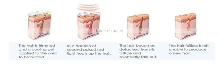 Factory supply 808nm diode laser hair removal machine for permanent hair removal painless