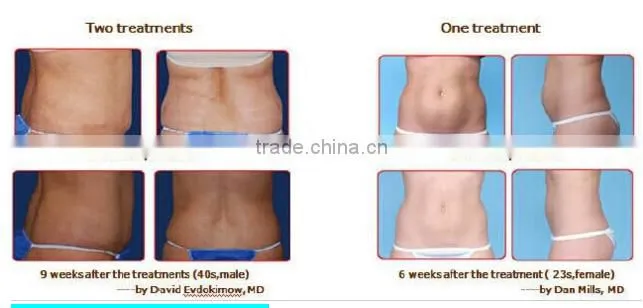 High effective multifunction cryo rf system freeze fat laser beauty equipment