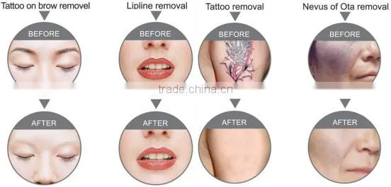 Lowest price ND YAG laser machine for tattoo removal