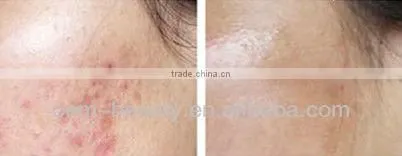 white handle paper box package zgts derma roller with lowest price