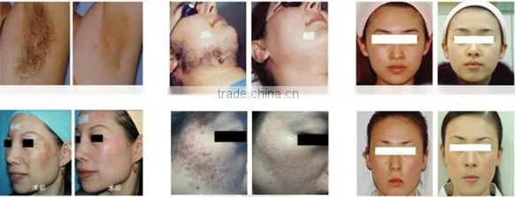 2016 IPL +OPT +SHR hair removal skin rejuvenation machine