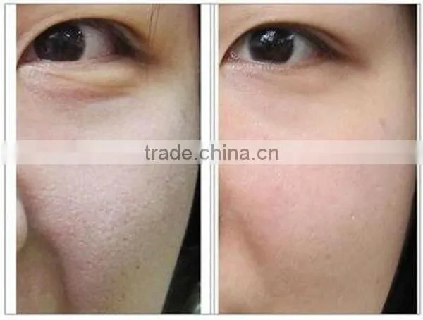 2013 Newest product! permanent lazer home hair removal device for the whole body BD-J005