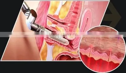 2016 Top selling rf fractional CO2 laser for scar removal skin resurfacing acne scar treatment