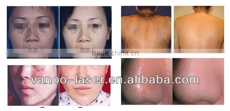 Ipl rf laser flash lamp ipl xenon lamp