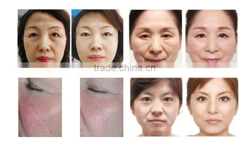 vacuum +bipolar rf + 40k ultrasonic cavitation + sextuple rf slimming machine