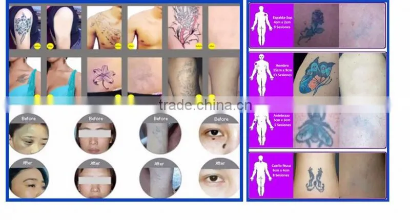 Bestview factory supply Tattoo Removal Equipment q-switch nd yag laser