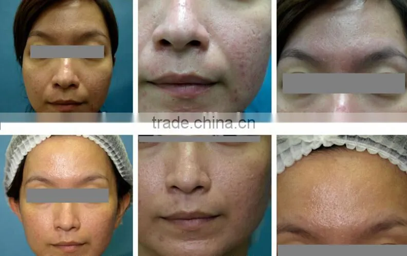 new products in china market best at home microdermabrasion machine
