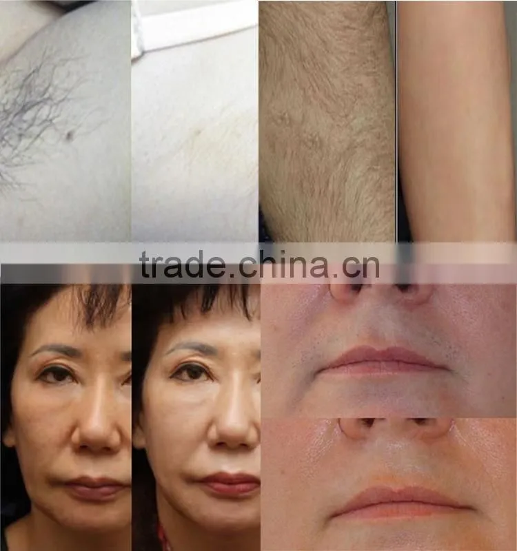 2014 Advanced Professional Hair Removal laser ipl shr in motion