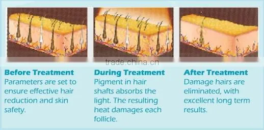 Bottom price hottest sale design device hot CE approved device for hair removal home ipl device