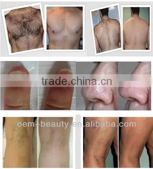 Medical laser treatment equipment for hair removal