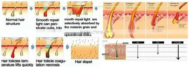 Hot selling!! AFT shr ipl acne treatment equipment/shr ipl rf elight/opt laser