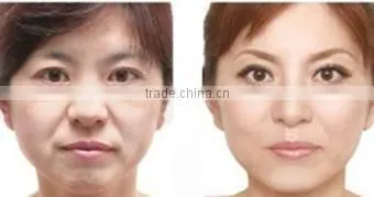 portable radiofrequency machine for skin tightening