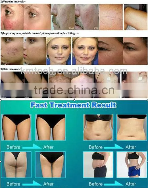 Newest IPL hoton led skin rejuvenation pdt machine for sale