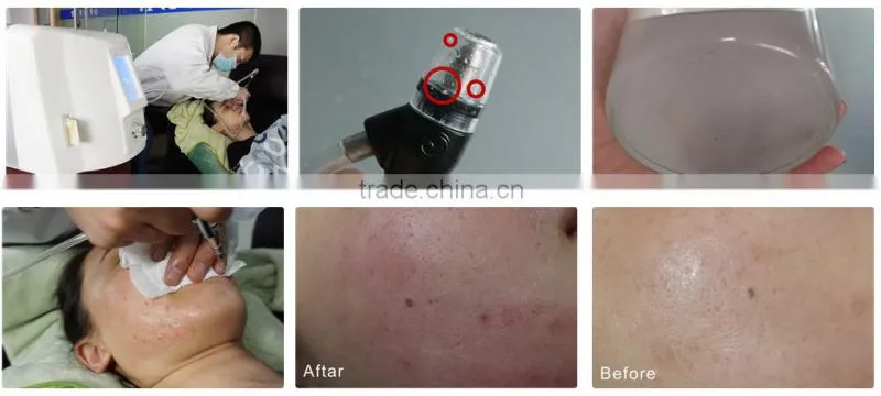 Negative pressure ionic face cleaning machine washing pores machine