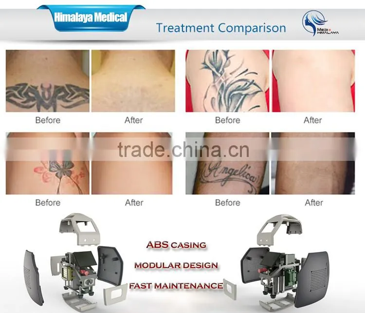 lowest price newest Medical CE Q switch laser acne removal machine