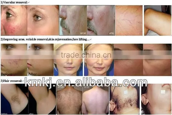 CE ISO professional 2in1 beauty-parlour-instrument with Nd Yag laser+Elight IPL