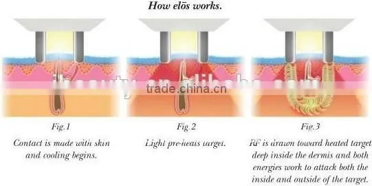 Wholesale low price high quality ipl shr laser